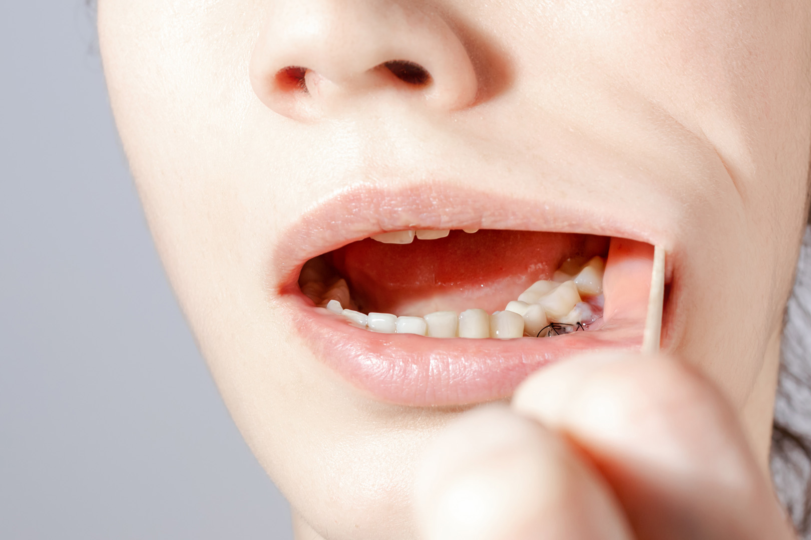 Closeup of gum recession site after gum grafting procedure