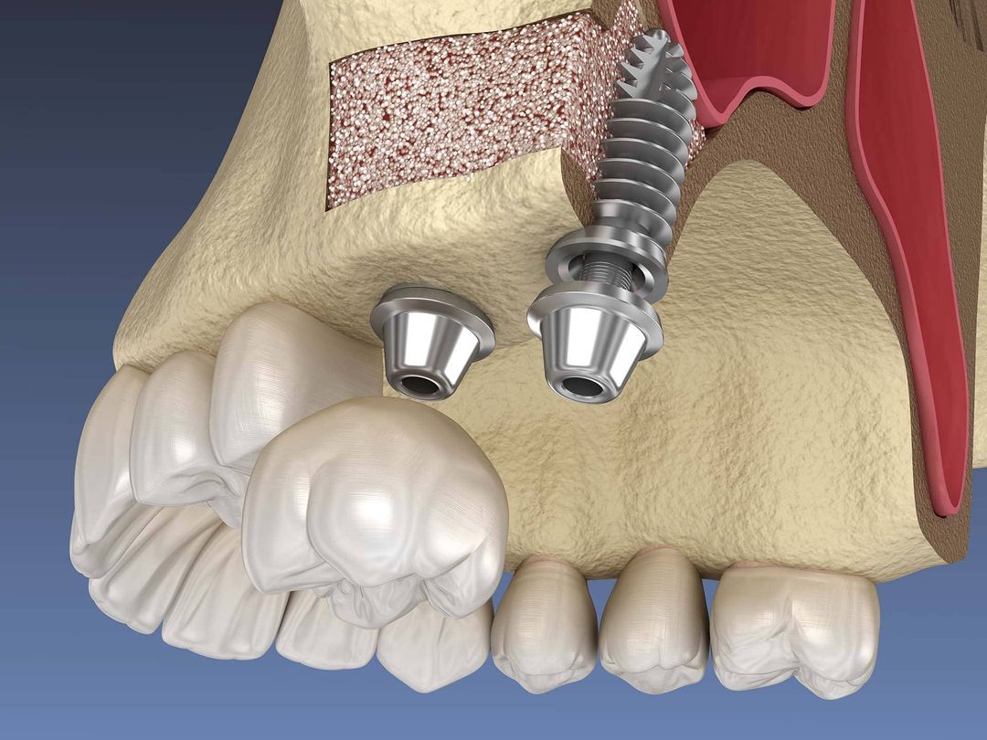 Sinus lift procedure illustration for dental implant preparation